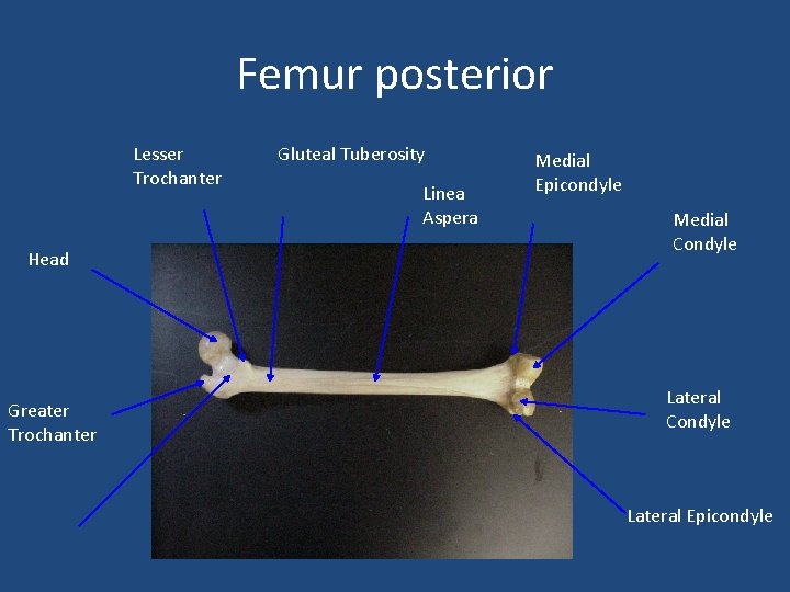 Femur posterior Lesser Trochanter Head Greater Trochanter Gluteal Tuberosity Linea Aspera Medial Epicondyle Medial