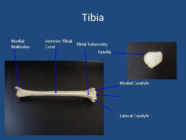 Tibia Medial Malleolus Anterior Tibial Tuberosity Crest Patella Medial Condyle Lateral Condyle 
