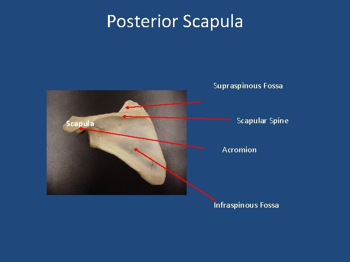 Posterior Scapula Supraspinous Fossa Scapular Spine Acromion Infraspinous Fossa 
