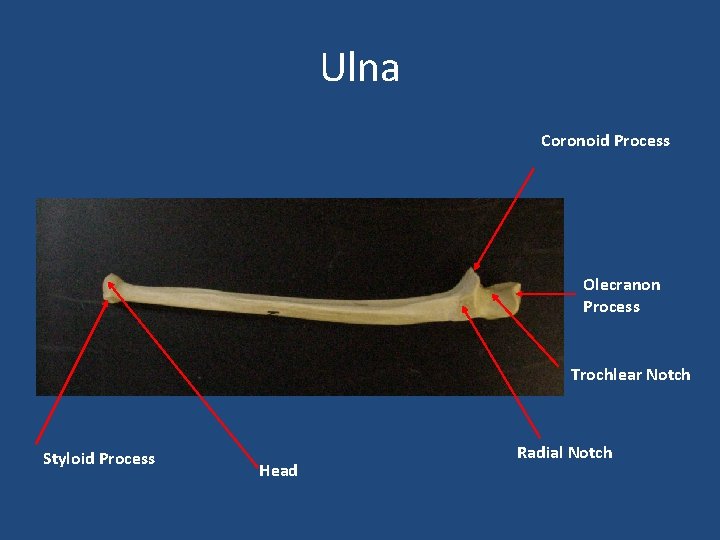 Ulna Coronoid Process Olecranon Process Trochlear Notch Styloid Process Head Radial Notch 