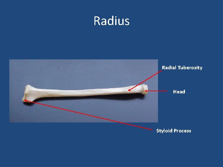 Radius Radial Tuberosity Head Styloid Process 