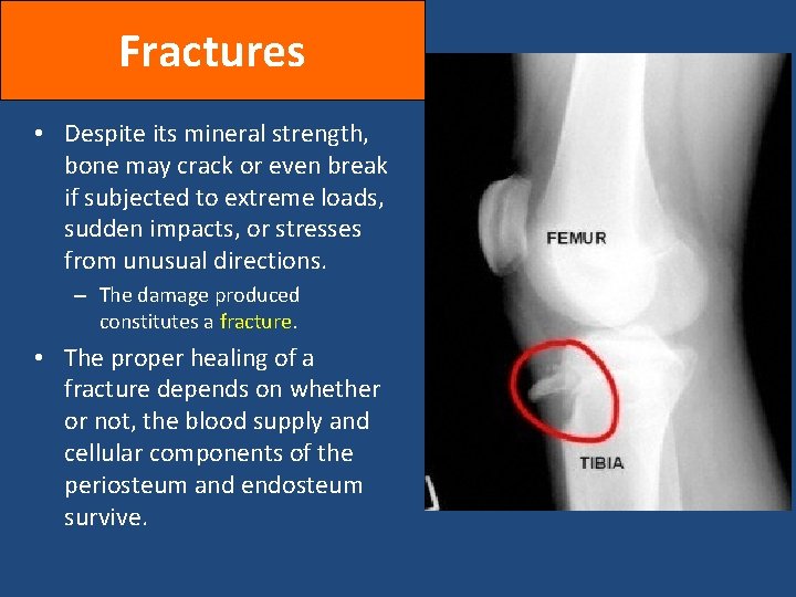 Fractures • Despite its mineral strength, bone may crack or even break if subjected