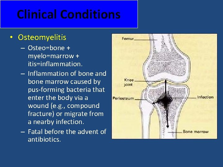 Clinical Conditions • Osteomyelitis – Osteo=bone + myelo=marrow + itis=inflammation. – Inflammation of bone