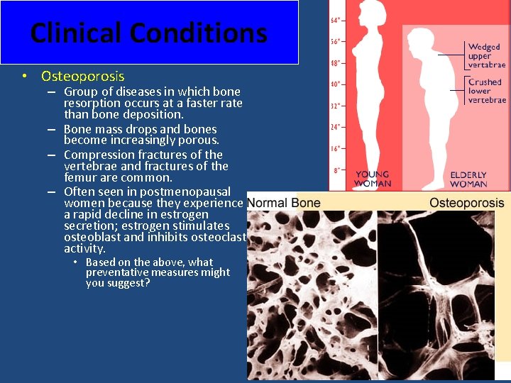 Clinical Conditions • Osteoporosis – Group of diseases in which bone resorption occurs at