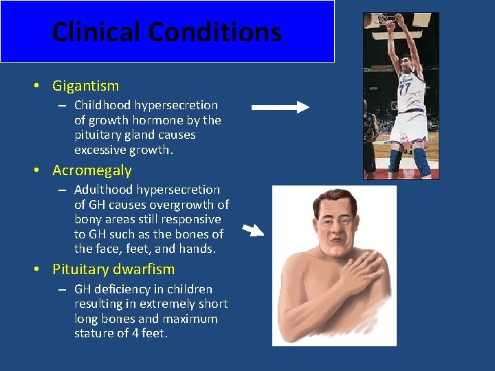 Clinical Conditions • Gigantism – Childhood hypersecretion of growth hormone by the pituitary gland