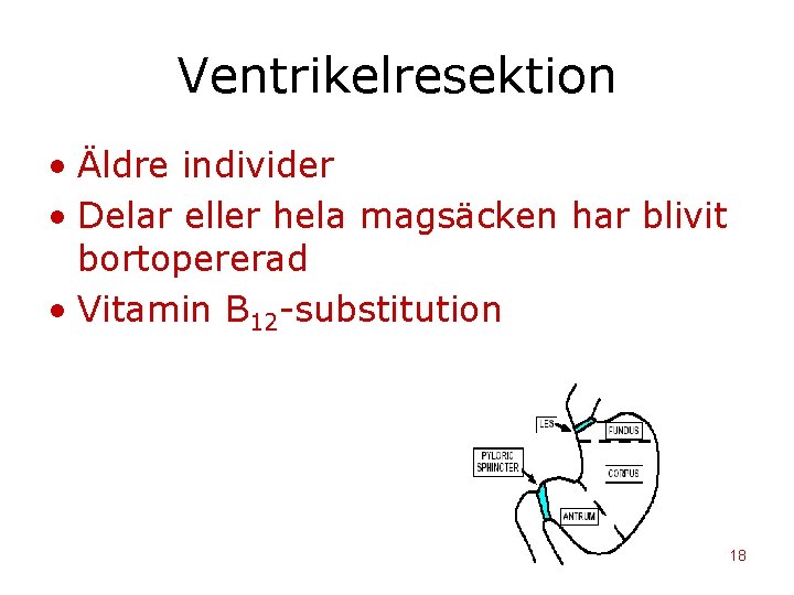 Ventrikelresektion • Äldre individer • Delar eller hela magsäcken har blivit bortopererad • Vitamin