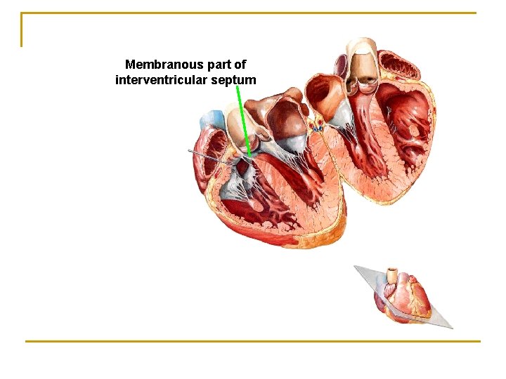 Membranous part of interventricular septum 