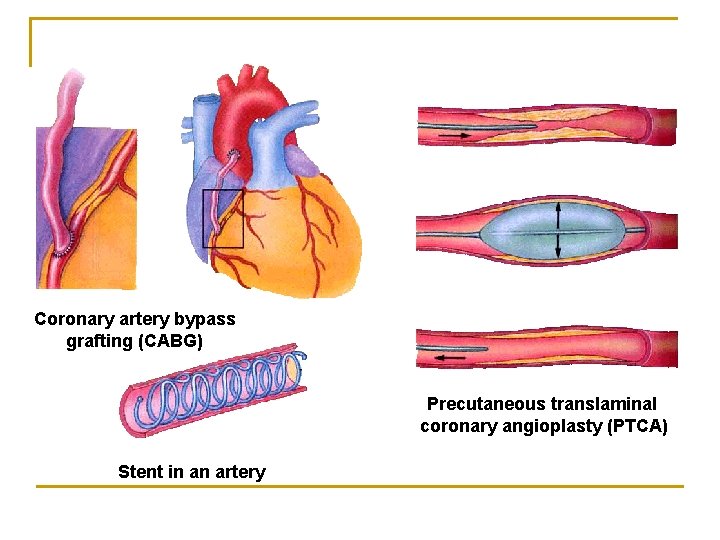 Coronary artery bypass grafting (CABG) Precutaneous translaminal coronary angioplasty (PTCA) Stent in an artery
