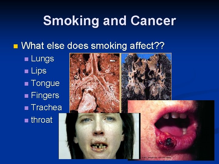 Smoking and Cancer n What else does smoking affect? ? Lungs n Lips n
