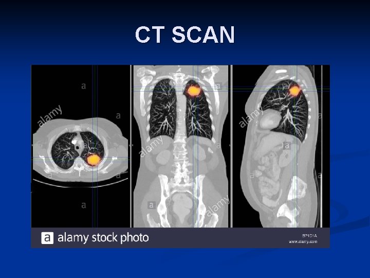 CT SCAN 