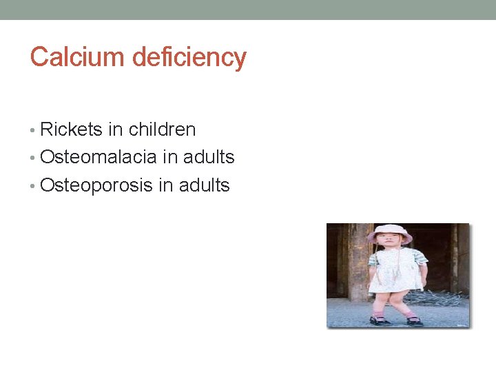 Calcium deficiency • Rickets in children • Osteomalacia in adults • Osteoporosis in adults