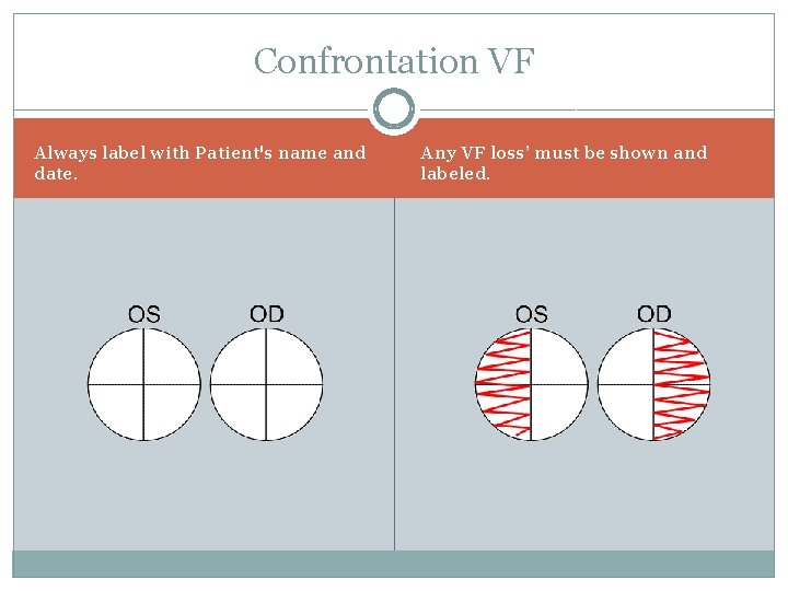 Confrontation VF Always label with Patient's name and date. Any VF loss’ must be