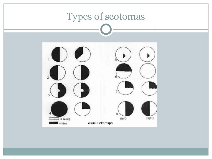 Types of scotomas 