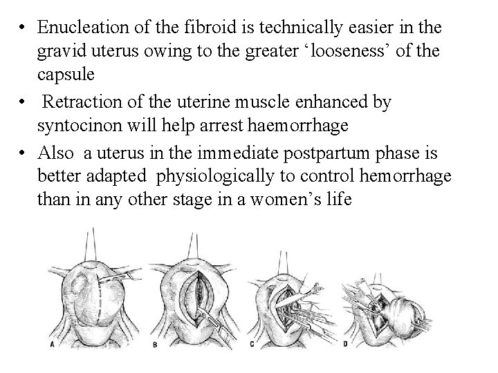  • Enucleation of the fibroid is technically easier in the gravid uterus owing