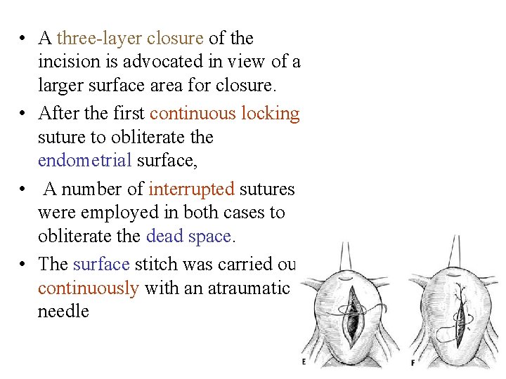 • A three-layer closure of the incision is advocated in view of a