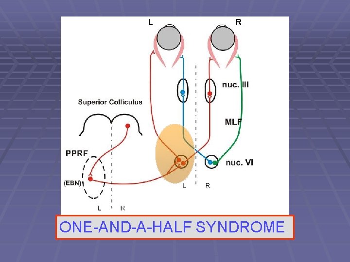 L R ONE-AND-A-HALF SYNDROME 