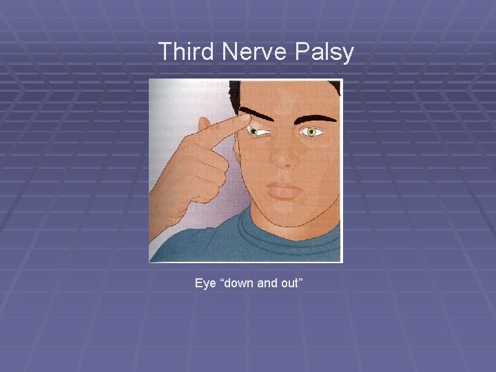 Third Nerve Palsy Eye “down and out” 
