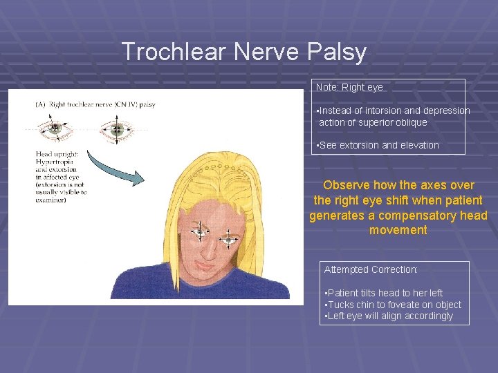 Trochlear Nerve Palsy Note: Right eye • Instead of intorsion and depression action of