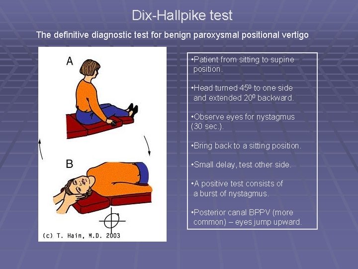 Dix-Hallpike test The definitive diagnostic test for benign paroxysmal positional vertigo • Patient from