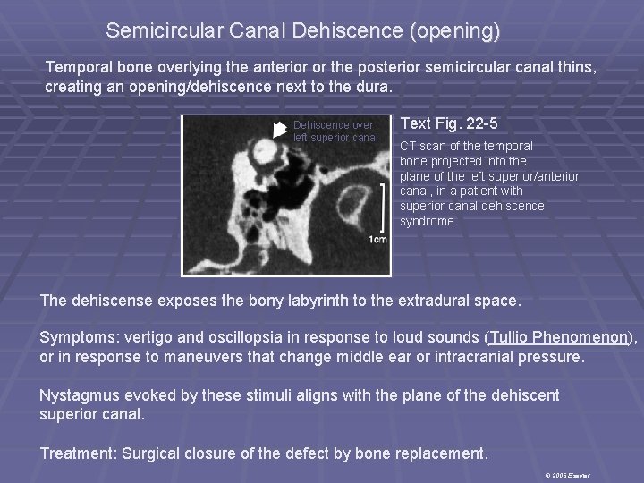 Semicircular Canal Dehiscence (opening) Temporal bone overlying the anterior or the posterior semicircular canal