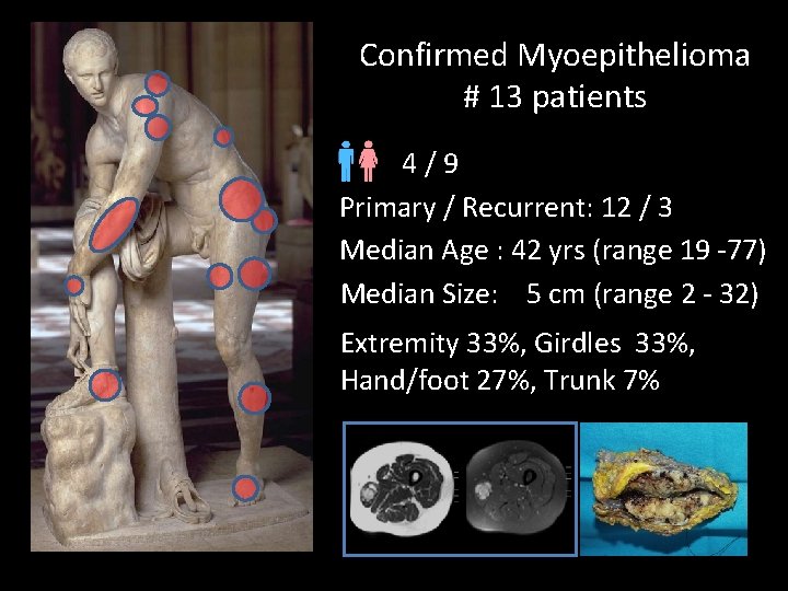 Confirmed Myoepithelioma # 13 patients 4/9 Primary / Recurrent: 12 / 3 Median Age Confirmed Myoepithelioma # 13 patients 4/9 Primary / Recurrent: 12 / 3 Median Age