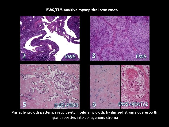 EWS/FUS positive myoepithelioma cases 2 5 EWS-PBX 3 3 EWS 6 EWS-NFATc 2 Variable EWS/FUS positive myoepithelioma cases 2 5 EWS-PBX 3 3 EWS 6 EWS-NFATc 2 Variable