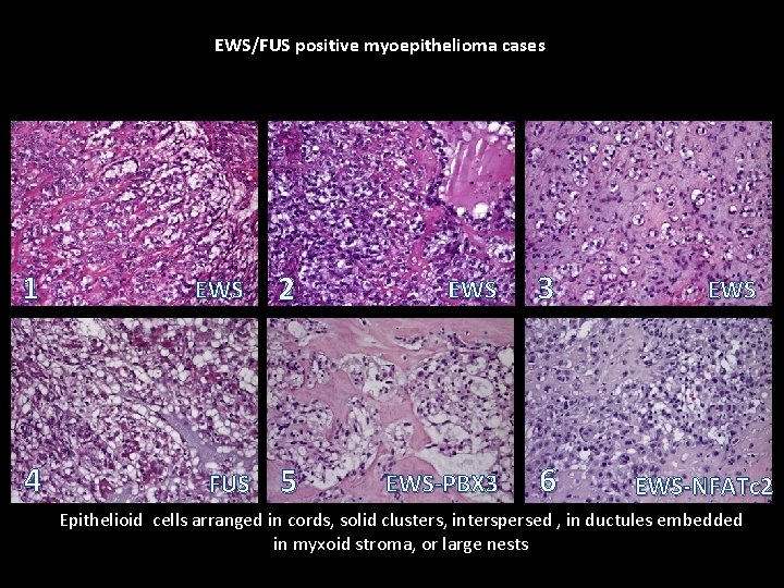 EWS/FUS positive myoepithelioma cases 1 EWS 2 EWS 3 4 FUS 5 EWS-PBX 3 EWS/FUS positive myoepithelioma cases 1 EWS 2 EWS 3 4 FUS 5 EWS-PBX 3