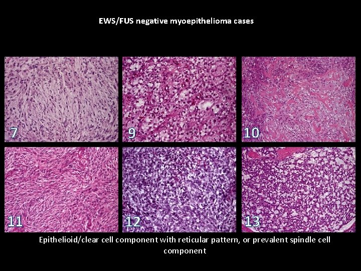 EWS/FUS negative myoepithelioma cases 7 9 10 11 12 13 Epithelioid/clear cell component with EWS/FUS negative myoepithelioma cases 7 9 10 11 12 13 Epithelioid/clear cell component with