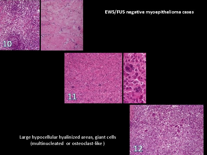 EWS/FUS negative myoepithelioma cases 10 11 Large hypocellular hyalinized areas, giant cells (multinucleated or EWS/FUS negative myoepithelioma cases 10 11 Large hypocellular hyalinized areas, giant cells (multinucleated or