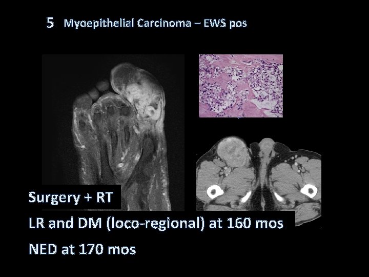 5 Myoepithelial Carcinoma – EWS pos SYT negative Surgery + RT LR and DM 5 Myoepithelial Carcinoma – EWS pos SYT negative Surgery + RT LR and DM