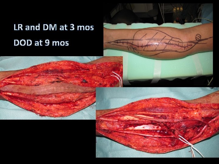 LR and DM at 3 mos DOD at 9 mos LR and DM at 3 mos DOD at 9 mos
