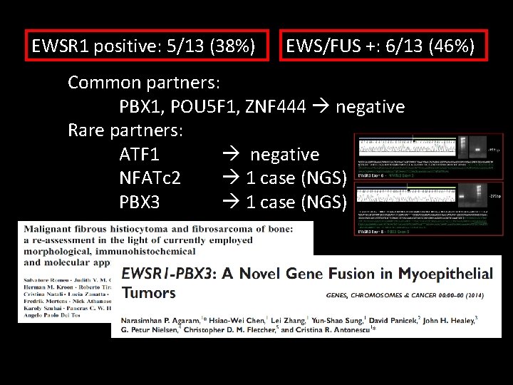 EWSR 1 positive: 5/13 (38%) EWS/FUS +: 6/13 (46%) Common partners: PBX 1, POU EWSR 1 positive: 5/13 (38%) EWS/FUS +: 6/13 (46%) Common partners: PBX 1, POU