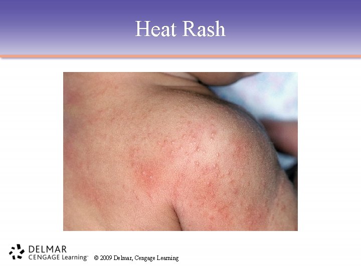 Heat Rash © 2009 Delmar, Cengage Learning 