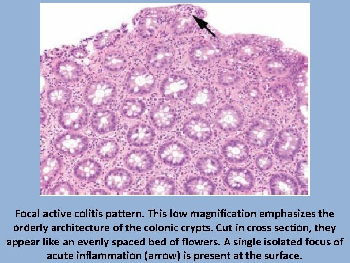 Focal active colitis pattern. This low magnification emphasizes the orderly architecture of the colonic