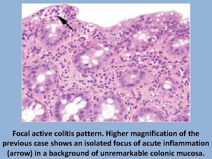 Focal active colitis pattern. Higher magnification of the previous case shows an isolated focus