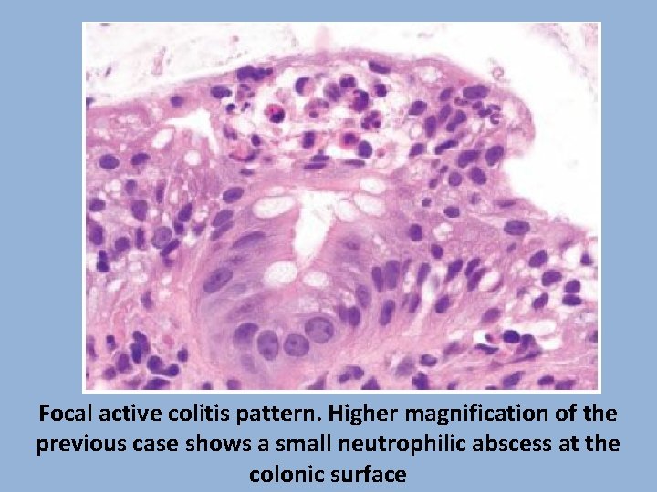 Focal active colitis pattern. Higher magnification of the previous case shows a small neutrophilic