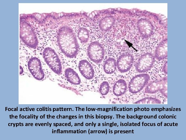 Focal active colitis pattern. The low-magnification photo emphasizes the focality of the changes in