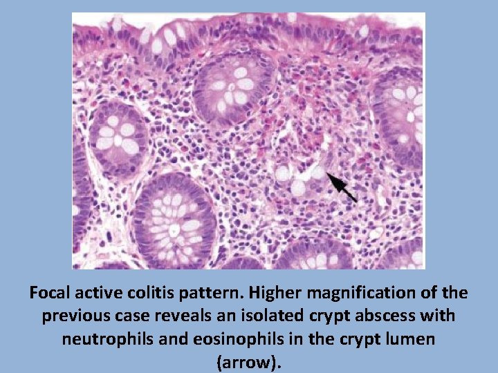 Focal active colitis pattern. Higher magnification of the previous case reveals an isolated crypt