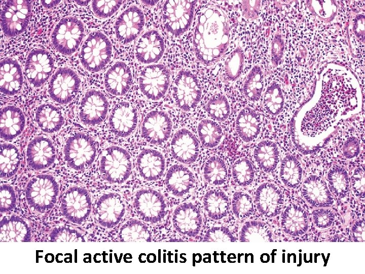 Focal active colitis pattern of injury 