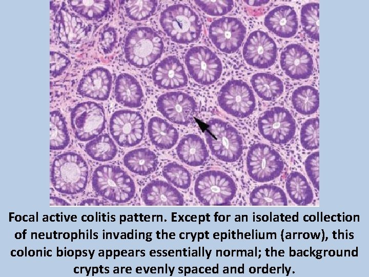Focal active colitis pattern. Except for an isolated collection of neutrophils invading the crypt