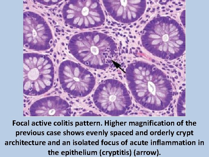 Focal active colitis pattern. Higher magnification of the previous case shows evenly spaced and