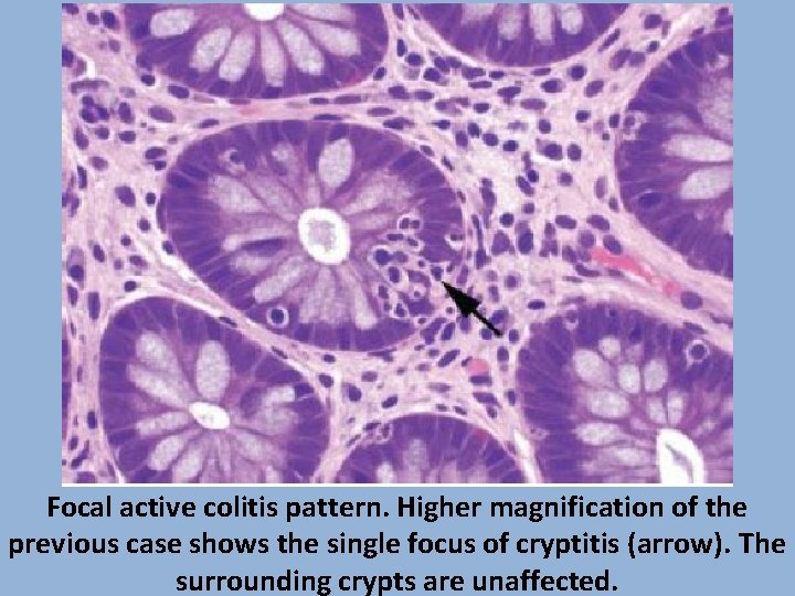 Focal active colitis pattern. Higher magnification of the previous case shows the single focus