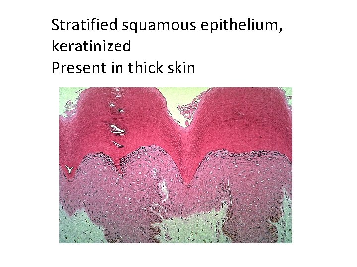 Stratified squamous epithelium, keratinized Present in thick skin 