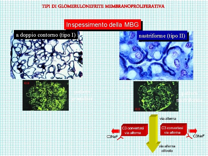 TIPI DI GLOMERULONEFRITE MEMBRANOPROLIFERATIVA Inspessimento della MBG a doppio contorno (tipo I) pattern granulare