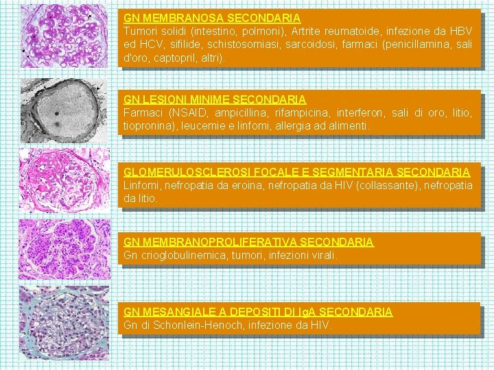 GN MEMBRANOSA SECONDARIA Tumori solidi (intestino, polmoni), Artrite reumatoide, infezione da HBV ed HCV,