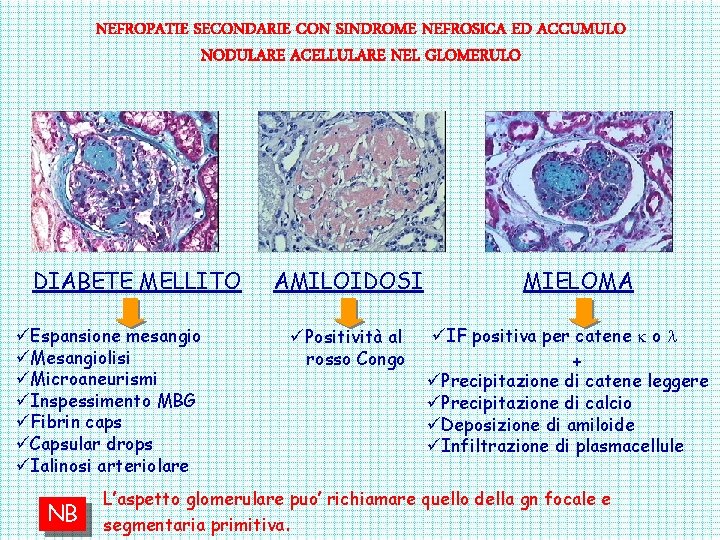 NEFROPATIE SECONDARIE CON SINDROME NEFROSICA ED ACCUMULO NODULARE ACELLULARE NEL GLOMERULO DIABETE MELLITO üEspansione