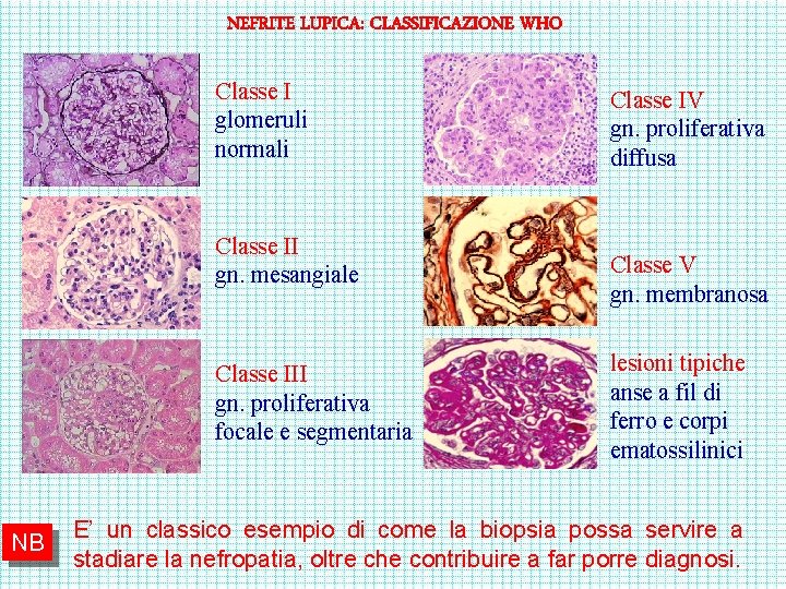 NEFRITE LUPICA: CLASSIFICAZIONE WHO Classe I glomeruli normali Classe II gn. mesangiale Classe III