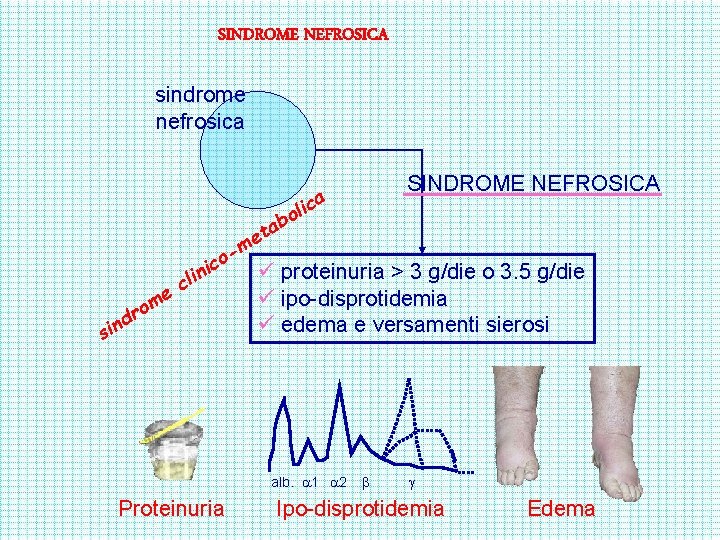 SINDROME NEFROSICA sindrome nefrosica me o r a c oli b a et SINDROME
