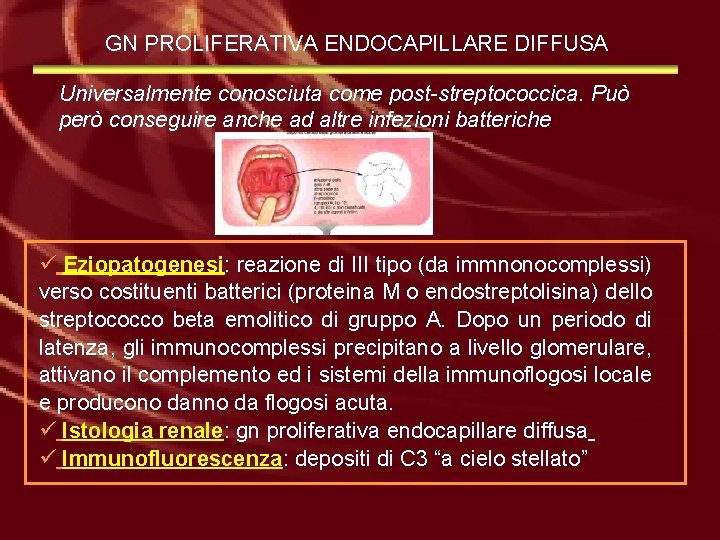 GN PROLIFERATIVA ENDOCAPILLARE DIFFUSA Universalmente conosciuta come post-streptococcica. Può però conseguire anche ad altre