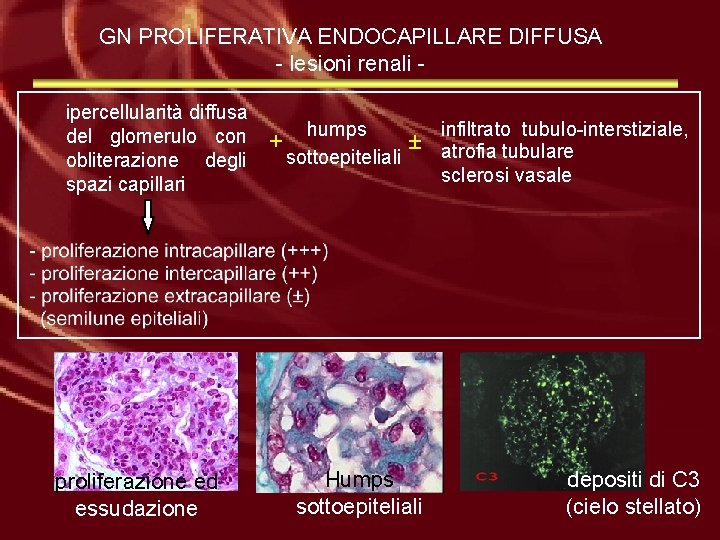 GN PROLIFERATIVA ENDOCAPILLARE DIFFUSA - lesioni renali ipercellularità diffusa del glomerulo con obliterazione degli